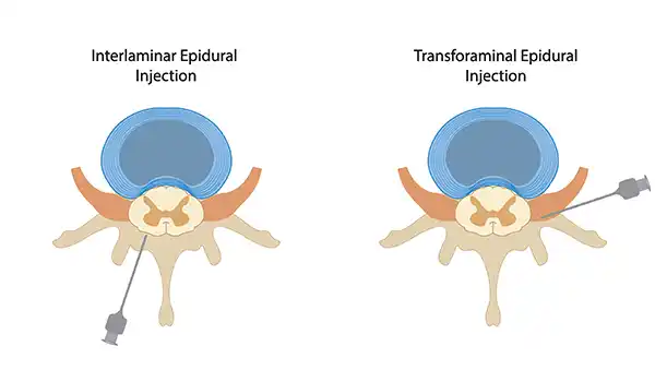 Info-graphic showing the different types of epidural injections for back pain relief offer at Premier Pain Management Arizona - with locations in Phoenix, Mesa and Queen Creek.