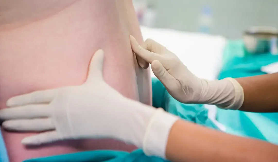 doctor performing epidural steroid injection for lower back nerve pain