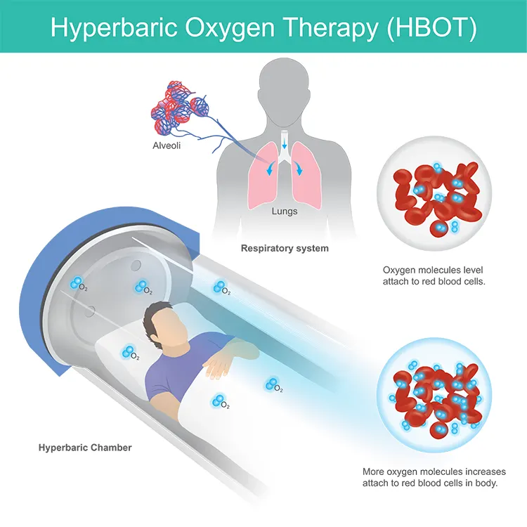 Hyperbaric oxygen therapy involves breathing pure oxygen inside a chamber where the air pressure is increased above normal levels. This pressure allows your lungs to take in significantly more oxygen, which then dissolves into the bloodstream and reaches tissues throughout the body.